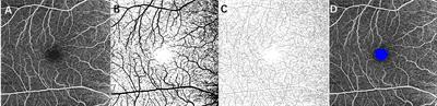 Quantifying ocular microcirculation in hypertension patients with carotid artery stenosis